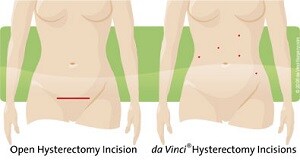 incision comparison of open surgery vs robotic surgery for hysterectomy